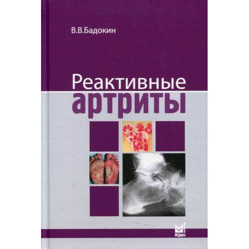 Реактивные артриты. Урогенитальные и постэнтероколитические